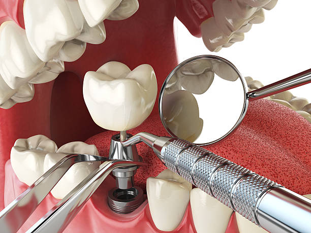 Best Emergency Wisdom Teeth Removal in Oakland, NE